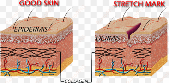 alteration of the dermis, gives rise to stretch marks - stretch marks cause