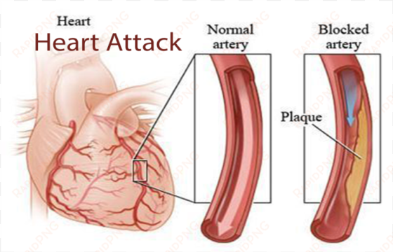 coronary artery disease คือ