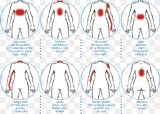 heart attack med illus - myocardial infarction