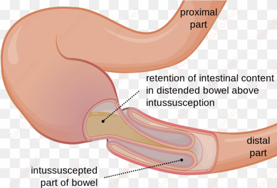 http - bowel intussusception