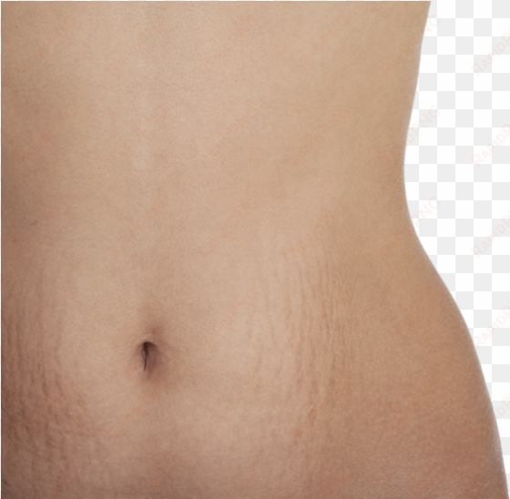 luckily, not everyone develops stretch marks - navel
