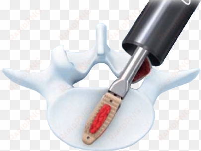 opal spacer system - opal synthes