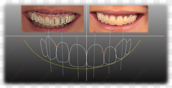 silvestre ripoll clínica dental - diseño de la sonrisa
