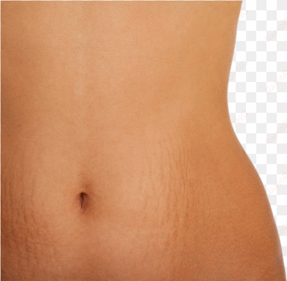 stretch marks are often the result of the rapid stretching - mild stomach stretch marks