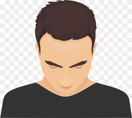 type 1 - - pattern hair loss